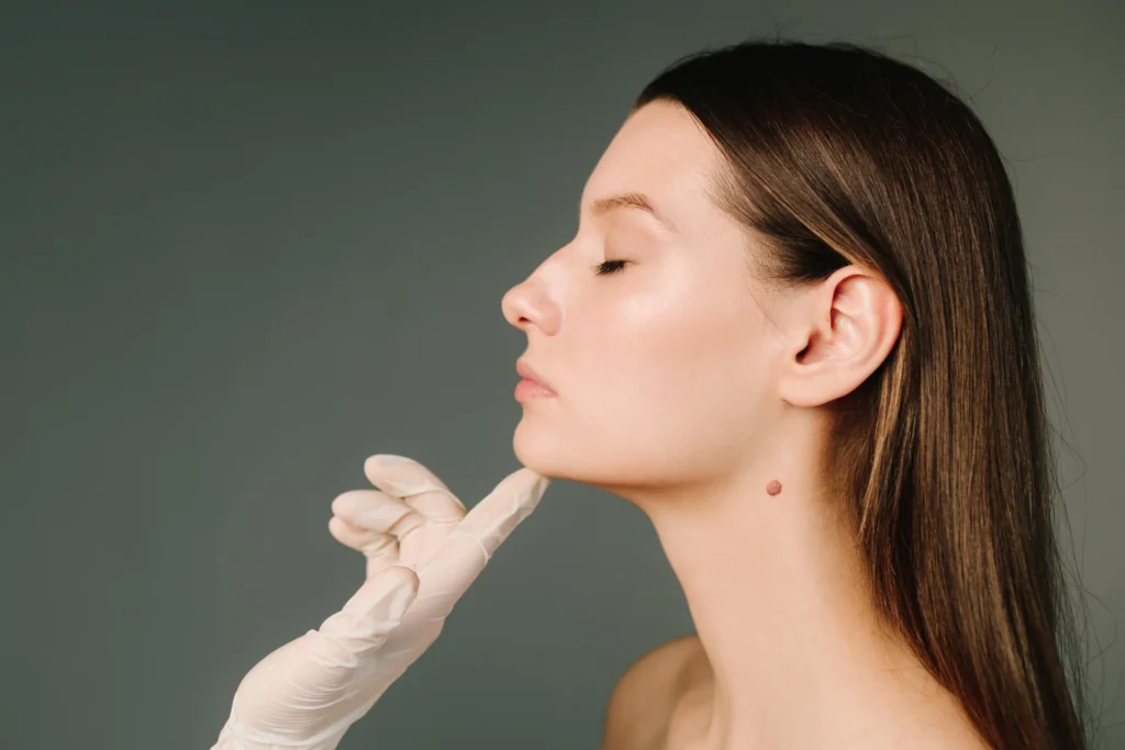 Chin Filler Tower Bridge Aesthetics Clinic 5