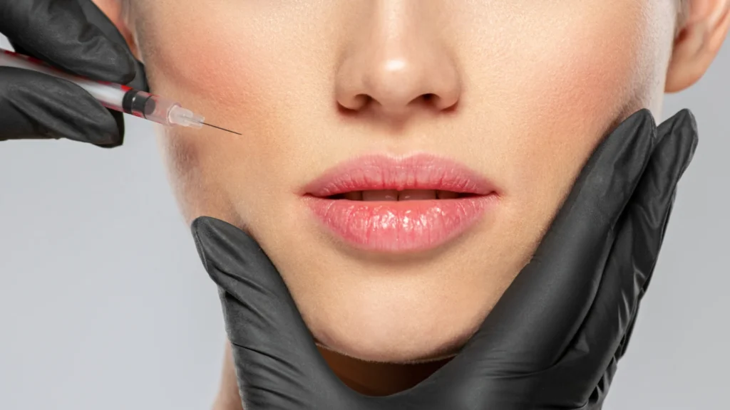Nasolabial Fold Filler Tower Bridge Aesthetics Clinic 3