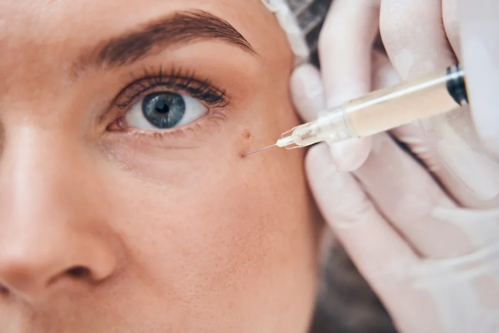 Tear Trough Filler Tower Bridge Aesthetics Clinic